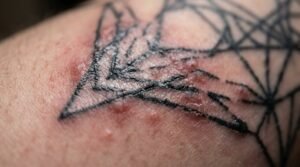 can you be allergic to tattoo ink
