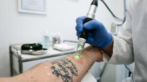 is laser tattoo removal safe