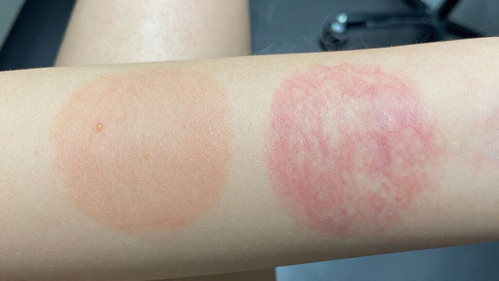 thinnest skin areas hurt most